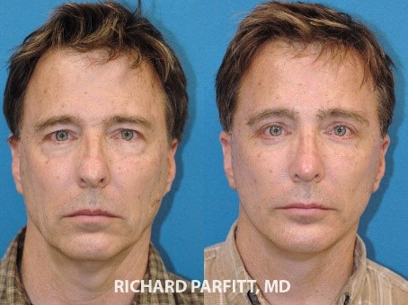 Before and After photos of man who underwent facelift